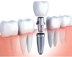 A Bridge Versus Dental Implants