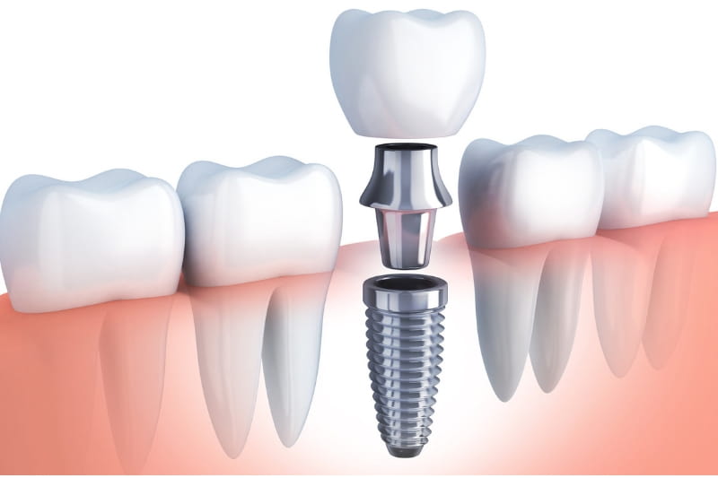 Bridge vs Dental implants
