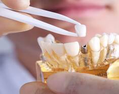 Why Can’t Teenagers Get Dental Implants