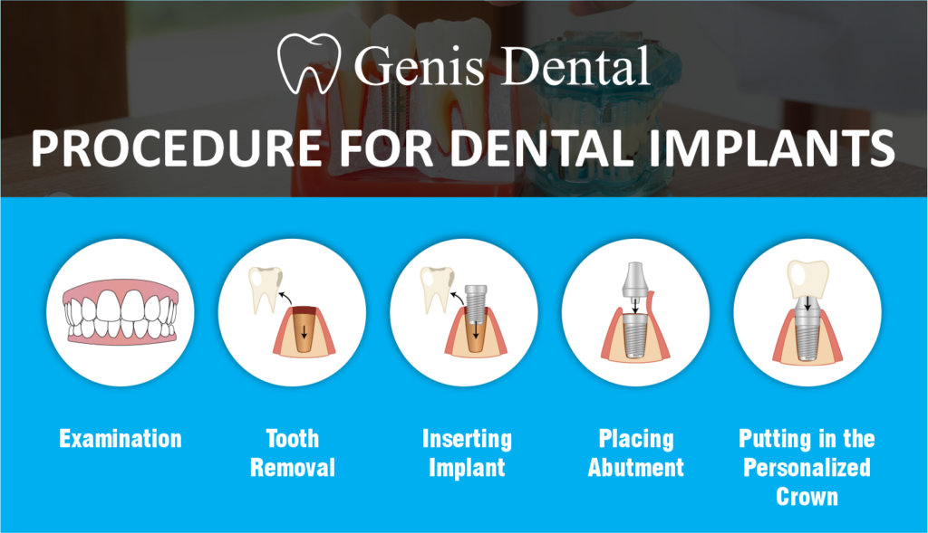 The Rundown on Dental Implants Pros and Cons Genis Dental