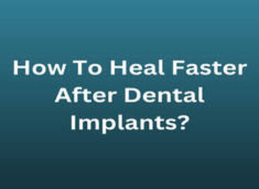How To Heal Faster After Dental Implants?
