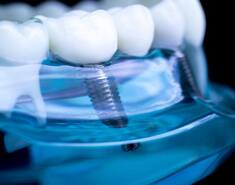 Philadelphia Dental Implant Dentist
